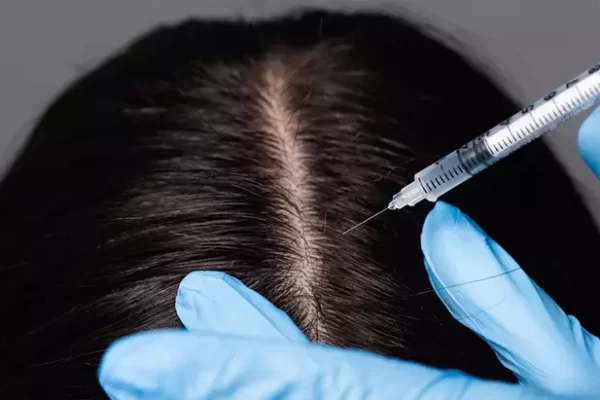 Saç Mezoterapisi