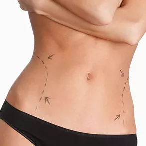 Karın Germe Ameliyatı – Abdominoplasti Hakkında Bilinmesi Gerekenler