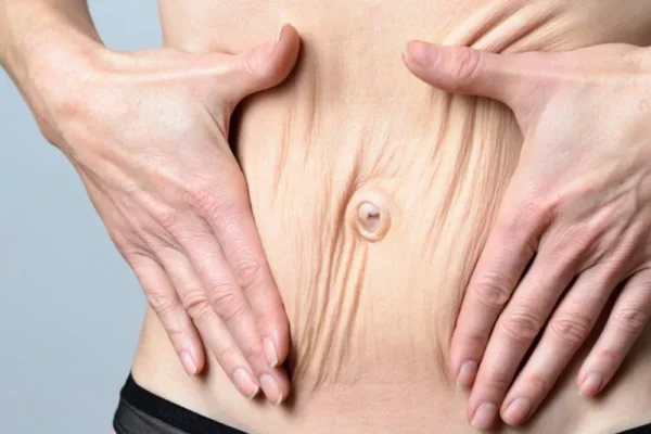 Aşırı Kilo Kayıpları Vücut Estetiği