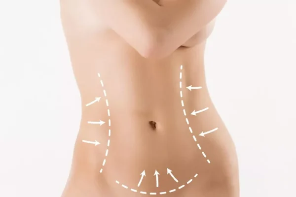 High Definition Vaser Liposculpture