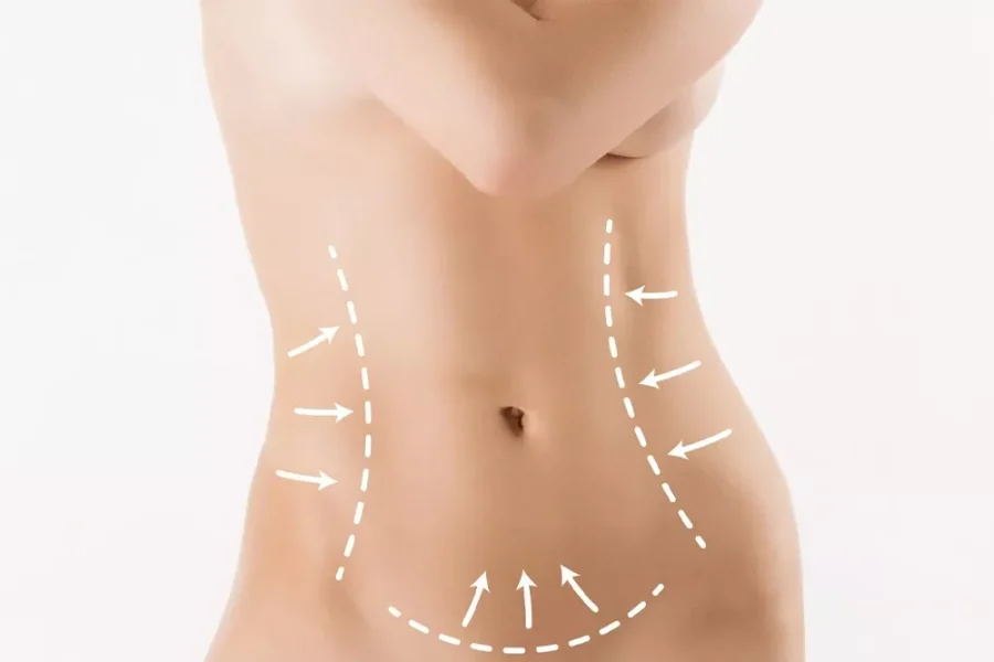 High Definition Vaser Liposculpture