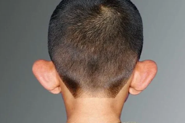 Kepçe Kulak Ameliyatsız Düzeltme Mümkün mü?