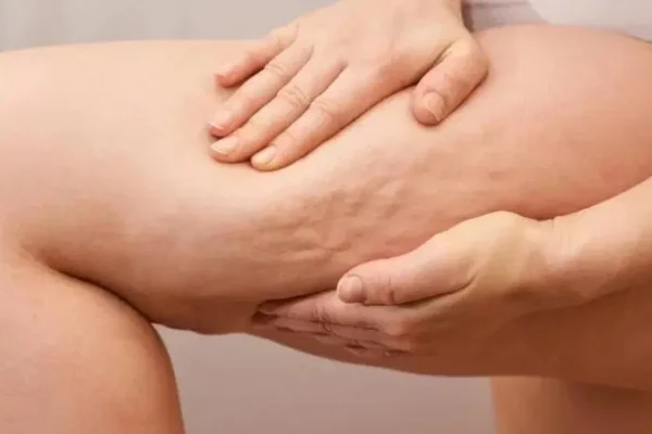 Lipodem Ameliyatı Kimlere Uygundur?