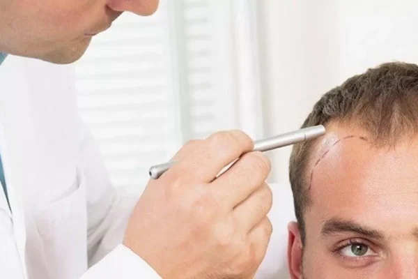 Saç Ekimi Sonrası 1 Ayda Neler Olur?