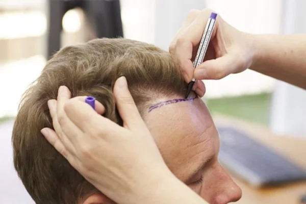 DHI ve FUE Saç Ekimi Arasındaki Farklar