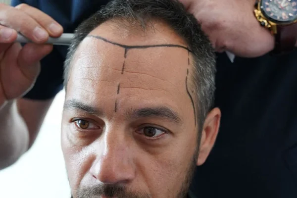 Saç Ekimi Yaptıranların En Sık Sorduğu 5 Soru